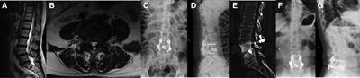 Changes in paraspinal muscles and facet joints after percutaneous endoscopic transforaminal lumbar interbody fusion for the treatment of lumbar spinal stenosis: A 3-year follow-up